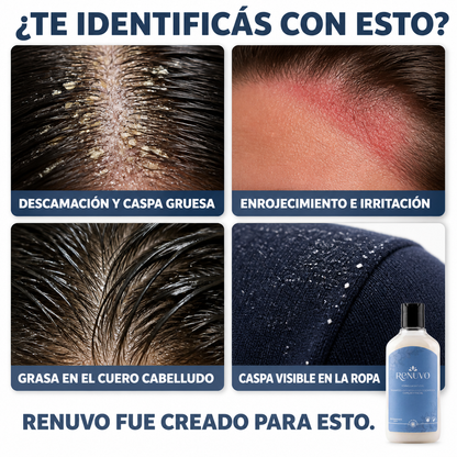 Shampoo RENUVO® Anti Seborrea y Psoriasis Capilar - Fórmula natural para Dermatitis Seborreica.