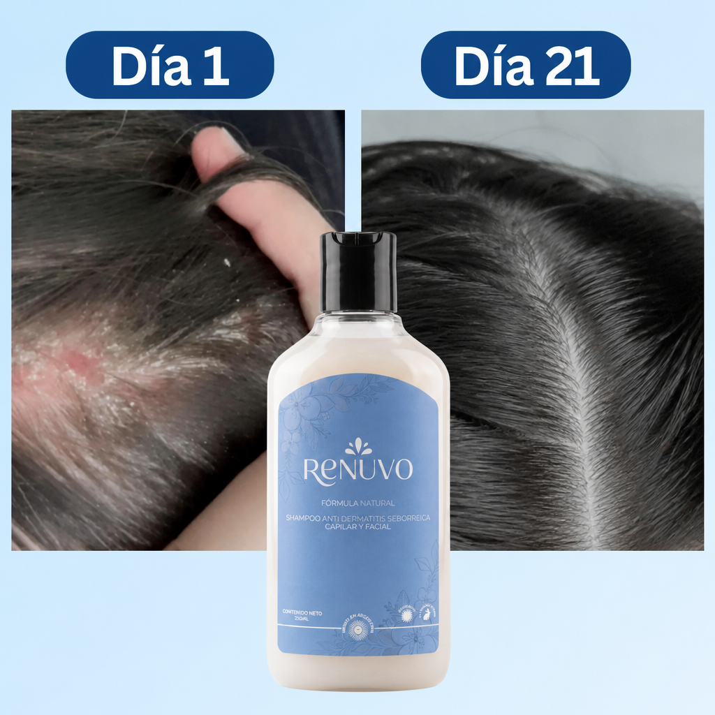Shampoo RENUVO® Anti Seborrea y Psoriasis Capilar - Fórmula natural para Dermatitis Seborreica.